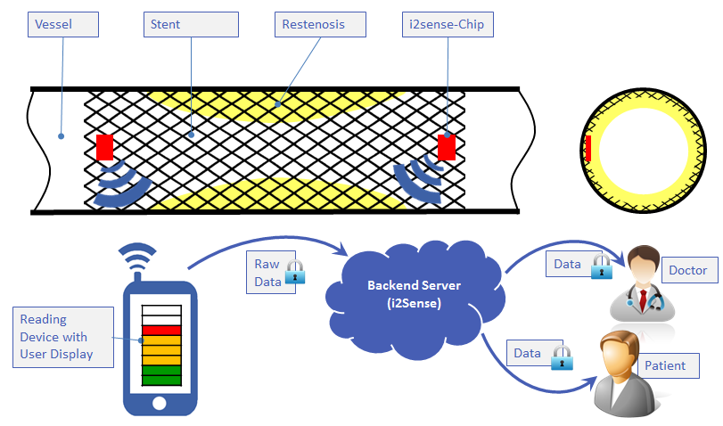 i2Sense: Development of an implantable health sensing system