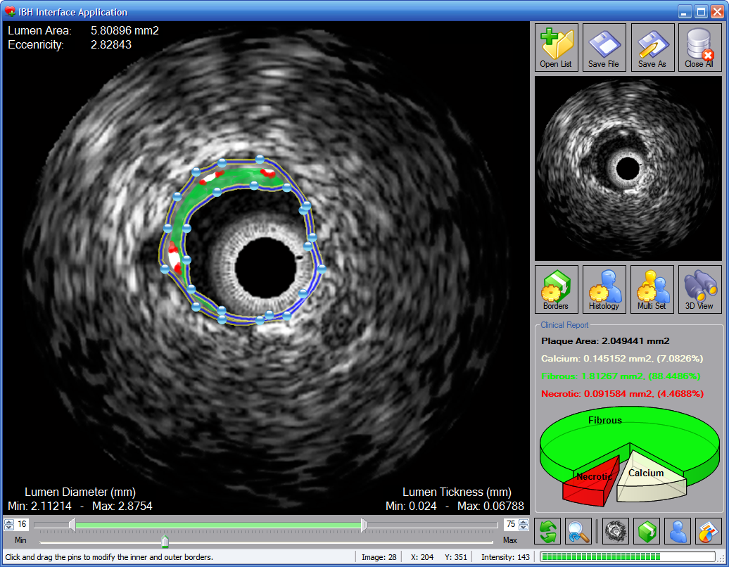 Improvement and Automatic Classification of IVUS-VH (Intravascular Ultrasound – Virtual Histology) Images