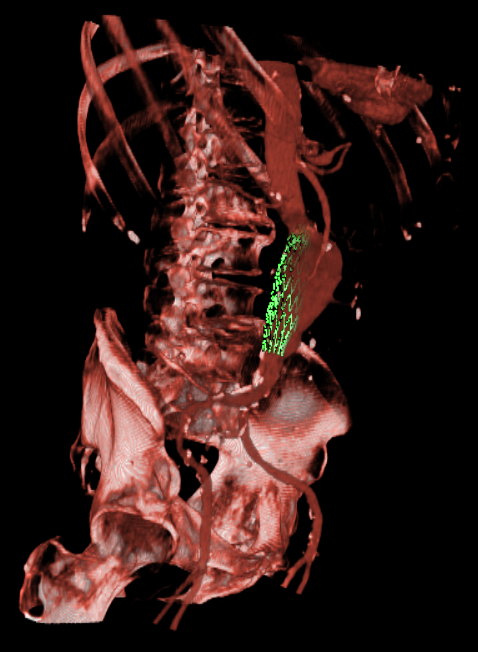 Endovascular Stenting of Aortic Aneurysms