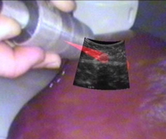 Real-time fusion of ultrasound and gamma probe for navigated localization of malignancy 