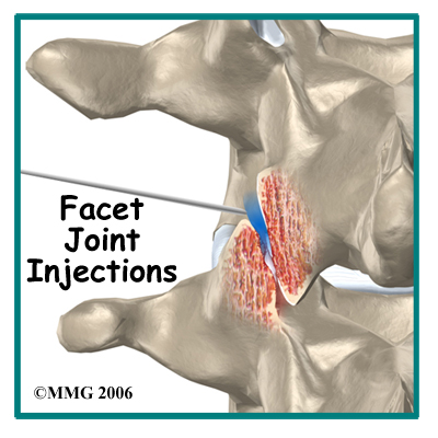 Facet joint infiltration