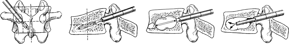 kyphoplasty-balloon-catheter-insertion-to-cement-injection.png