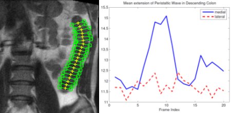 Analysis and Visualization of Colon Motility