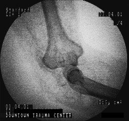 X-Ray radiography of the model