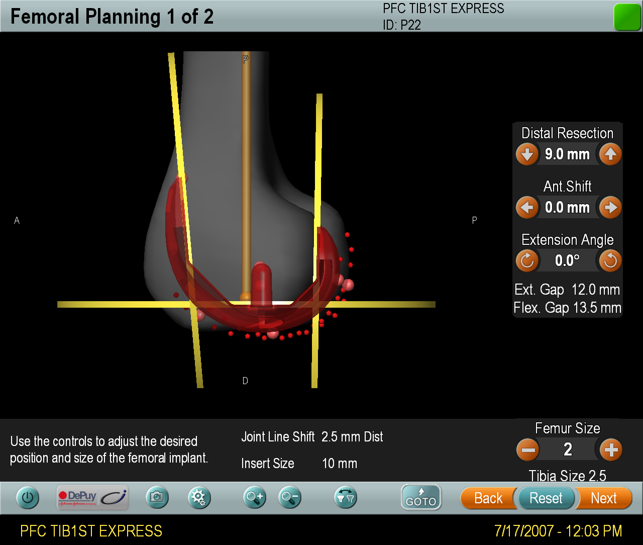 PFCTIB1STEXPRESS_Automatic_Planning_Femoral_1_Initial.png