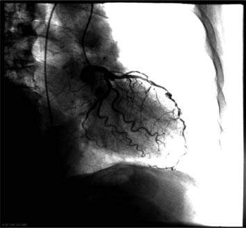 Radiograph of contrasted coronary arteries