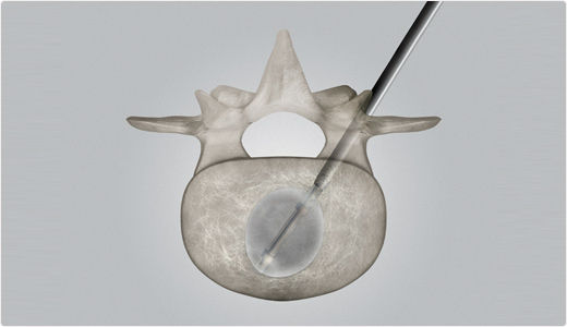 spine-augmentation-system-balloon-catheter-percutaneous-kyphoplasty-75330-2997655.jpg