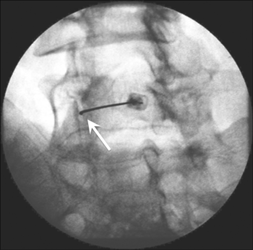 Fluoroscopy-guided lumbar facet joint injection at L4–5. The oblique spot image shows the intra-articular position of the needle (arrow).