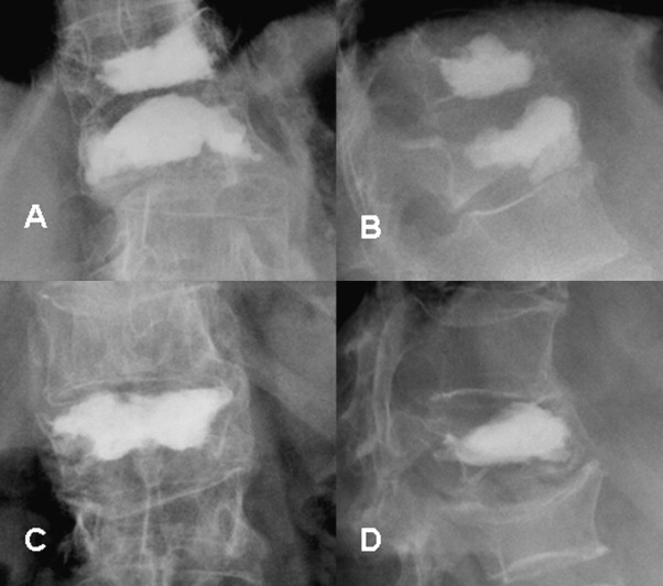 Cement in osteoporotic vertebra