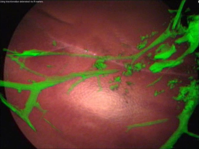 Laparoscope Augmentation for Minimally Invasive Liver Resection